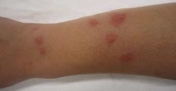 bed bug bites