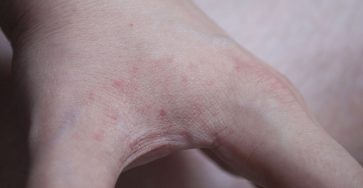 bed bug bites itch
