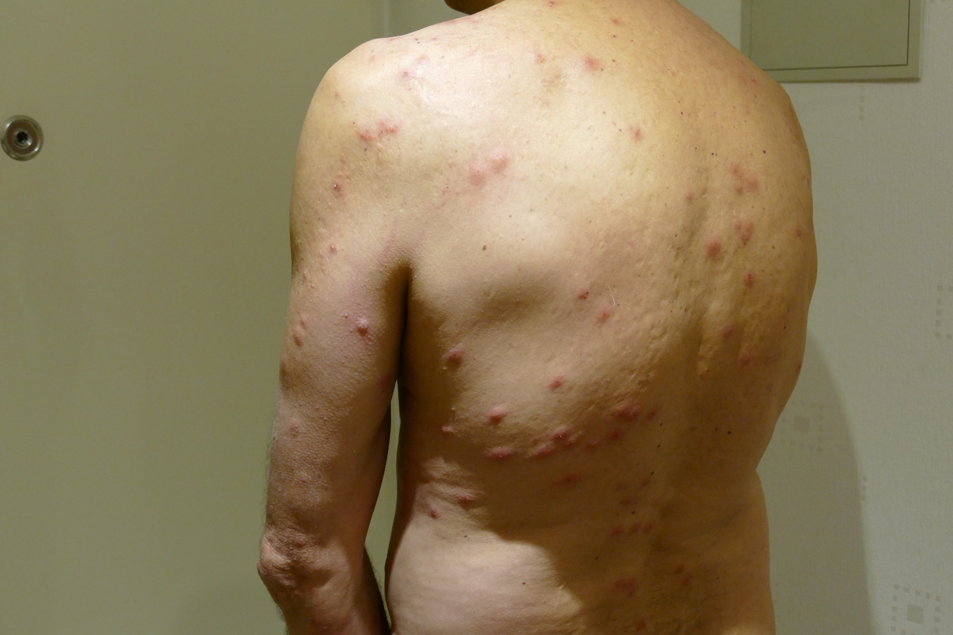 bed bug bites pictures