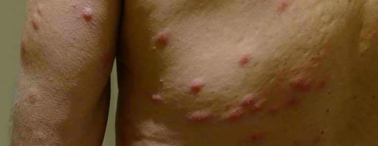 bed bug bite symptoms