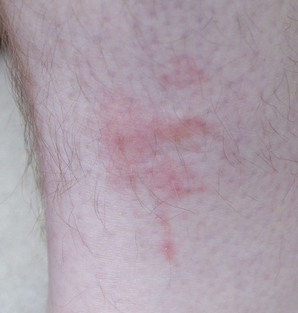 bedbug bites on leg