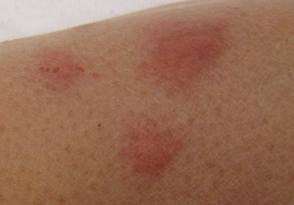 beg bug bites on skin - closer view