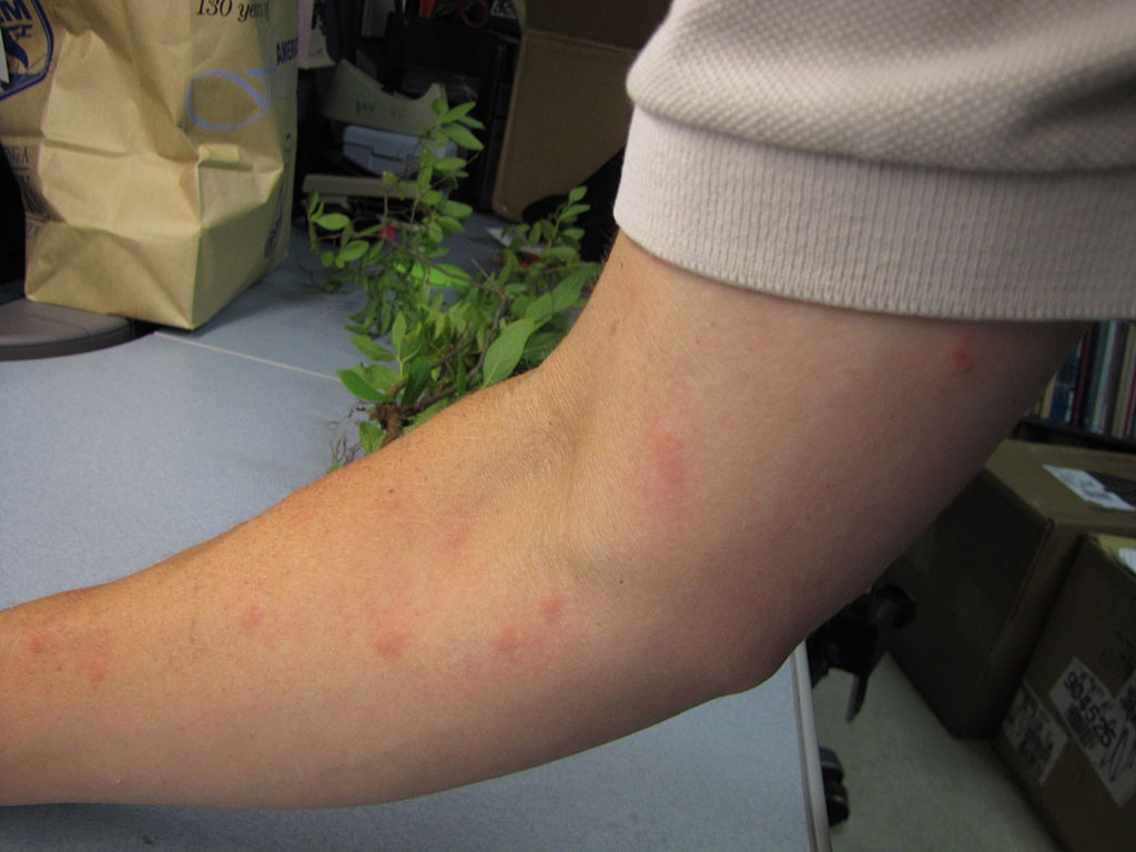 mosquito bites on arm
