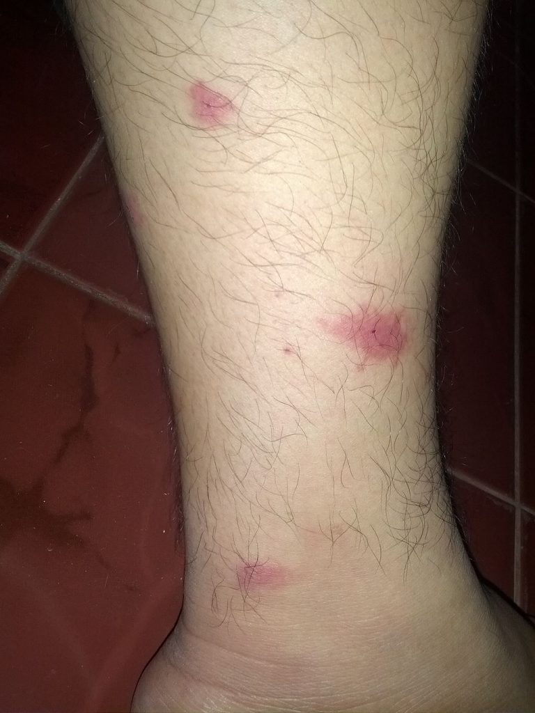 mosquito bites on leg
